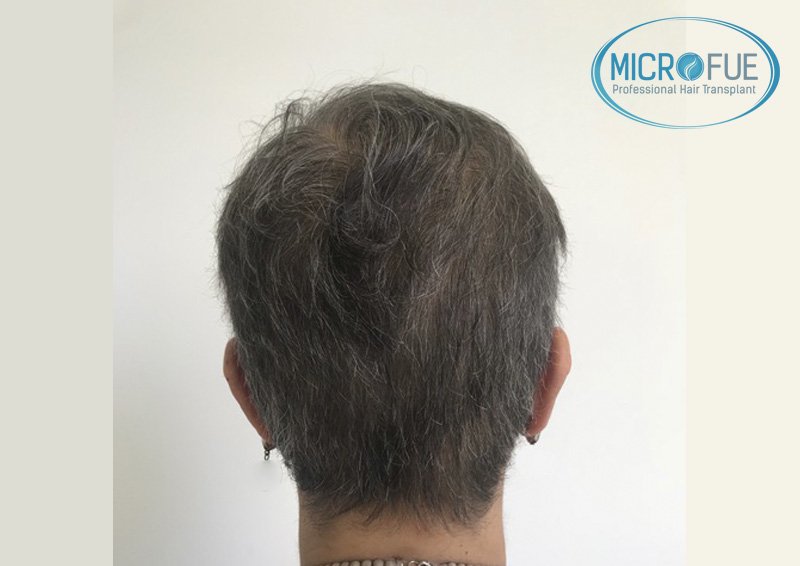 trasplante_de_pelo_mujer_Turquia_Microfue_1 trasplante_de_pelo_mujer_Turquia_Microfue_1
