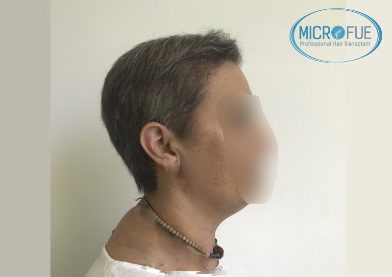 trasplante_de_pelo_mujer_Turquia_Microfue_2 trasplante_de_pelo_mujer_Turquia_Microfue_2