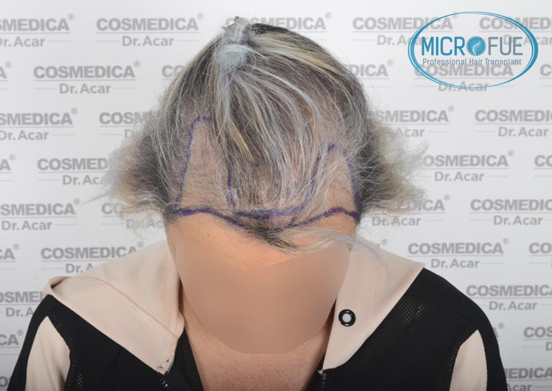 trasplante_de_pelo_mujer_Turquia_Microfue_5 trasplante_de_pelo_mujer_Turquia_Microfue_5