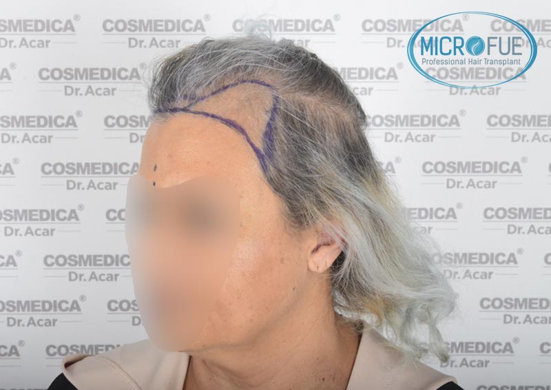 trasplante_de_pelo_mujer_Turquia_Microfue_7 trasplante_de_pelo_mujer_Turquia_Microfue_7