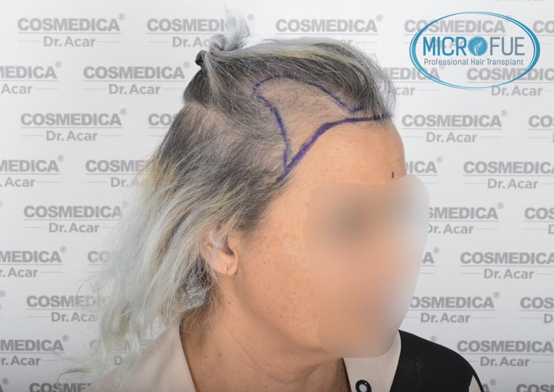 trasplante_de_pelo_mujer_Turquia_Microfue_8 trasplante_de_pelo_mujer_Turquia_Microfue_8