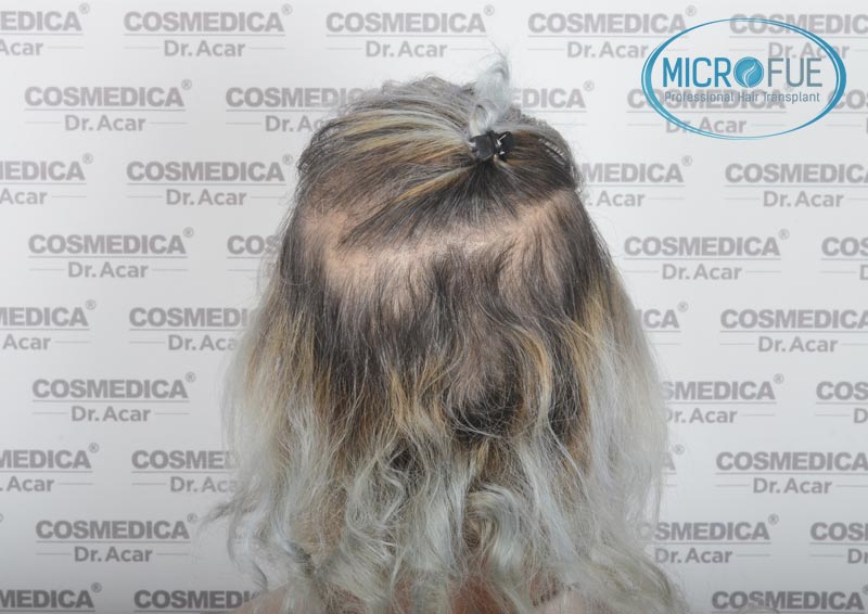 trasplante_de_pelo_mujer_Turquia_Microfue_9 trasplante_de_pelo_mujer_Turquia_Microfue_9