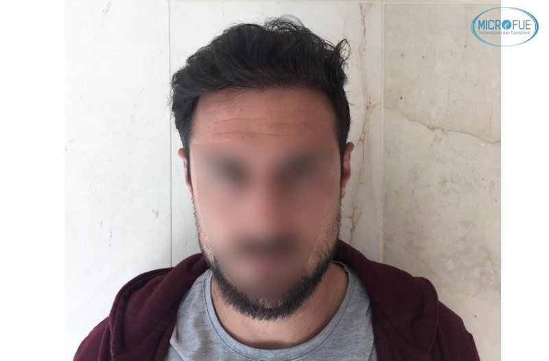 casos de trasplante capilar en turquía_Microfue (10) casos de trasplante capilar en turquía_Microfue (10)