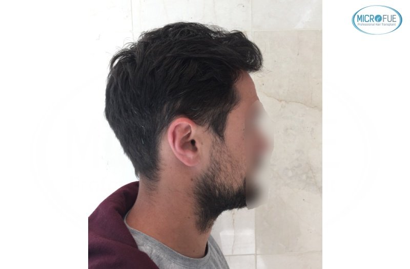 casos de trasplante capilar en turquía_Microfue (11) casos de trasplante capilar en turquía_Microfue (11)