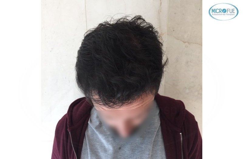 casos de trasplante capilar en turquía_Microfue (12) casos de trasplante capilar en turquía_Microfue (12)