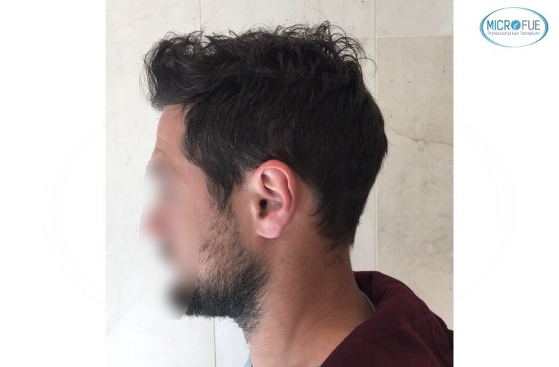 casos de trasplante capilar en turquía_Microfue (14) casos de trasplante capilar en turquía_Microfue (14)
