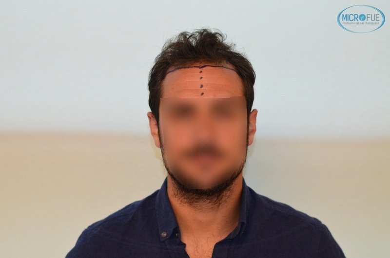 casos de trasplante capilar en turquía_Microfue (3) casos de trasplante capilar en turquía_Microfue (3)