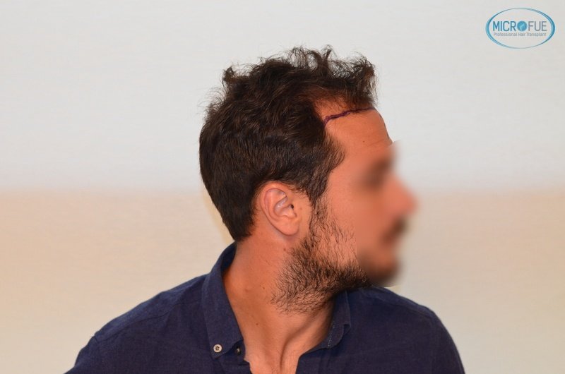 casos de trasplante capilar en turquía_Microfue (4) casos de trasplante capilar en turquía_Microfue (4)