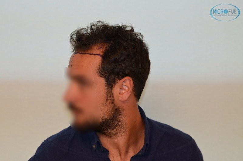casos de trasplante capilar en turquía_Microfue (5) casos de trasplante capilar en turquía_Microfue (5)