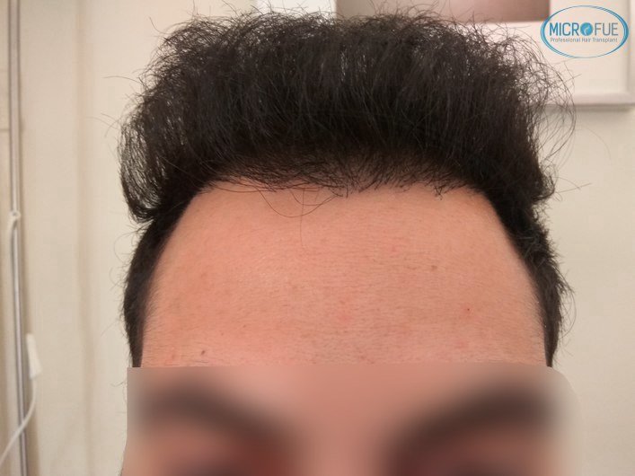 injerto capilar trasplante de pelo en Turquia FUE Microfue (13) injerto capilar trasplante de pelo en Turquia FUE Microfue (13)