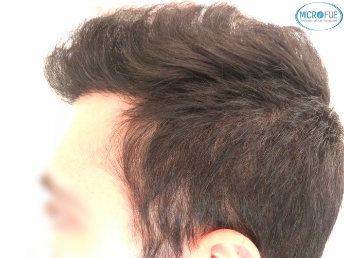 injerto capilar trasplante de pelo en Turquia FUE Microfue (14) injerto capilar trasplante de pelo en Turquia FUE Microfue (14)