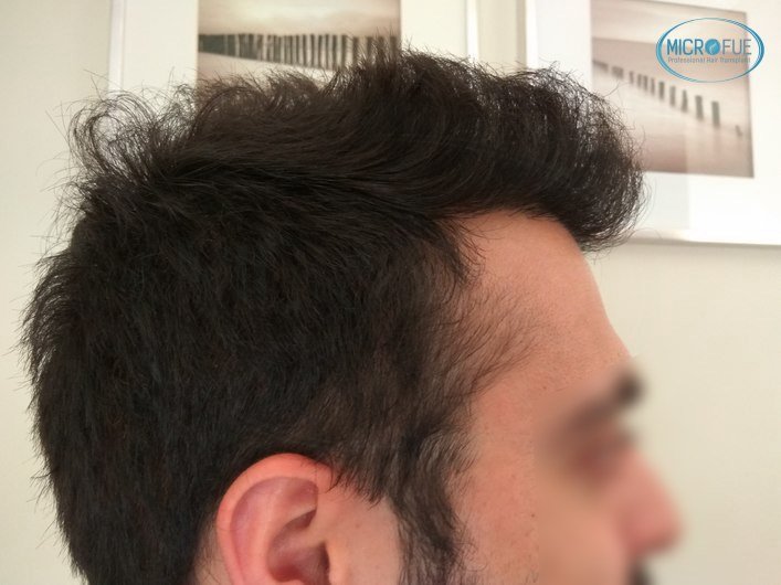 injerto capilar trasplante de pelo en Turquia FUE Microfue (15)