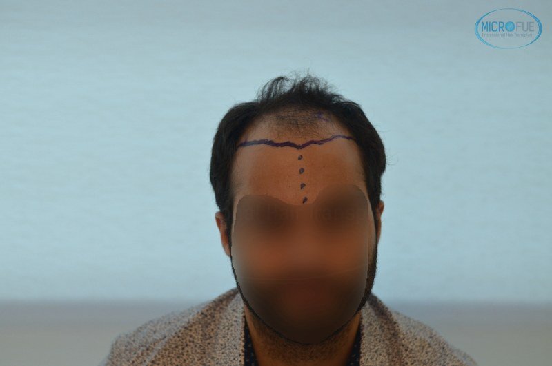 injerto capilar trasplante de pelo en Turquia FUE Microfue (3)