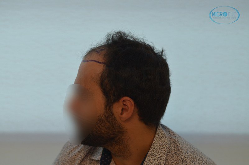 injerto capilar trasplante de pelo en Turquia FUE Microfue (5)