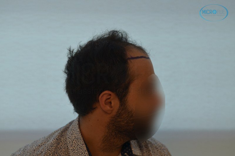 injerto capilar trasplante de pelo en Turquia FUE Microfue (6) injerto capilar trasplante de pelo en Turquia FUE Microfue (6)