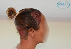 Implante de pelo en mujeres es efectivo