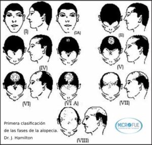 clasificación Hamilton grados de alopecia