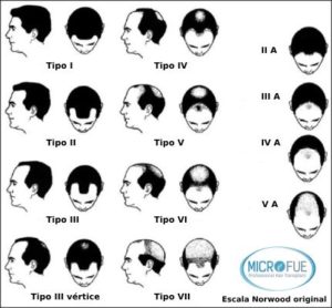 escala Norwood clasificación de la calvicie