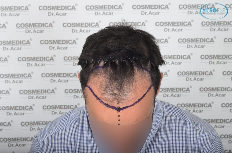trasplante capilar en Turquía con Microfue resultados excelentes_10(1) trasplante capilar en Turquía con Microfue resultados excelentes_10(1)