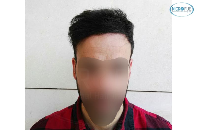 trasplante capilar en Turquía con Microfue resultados excelentes_1(1) trasplante capilar en Turquía con Microfue resultados excelentes_1(1)