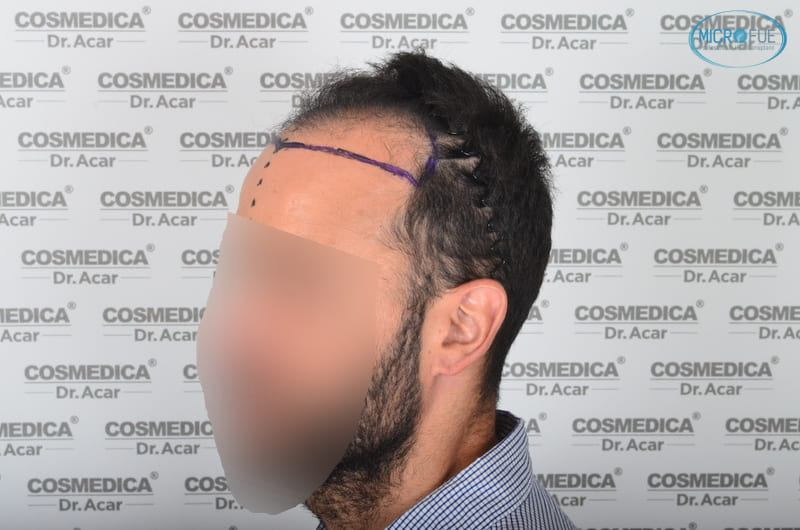 trasplante capilar en Turquía con Microfue resultados excelentes_12(1) trasplante capilar en Turquía con Microfue resultados excelentes_12(1)