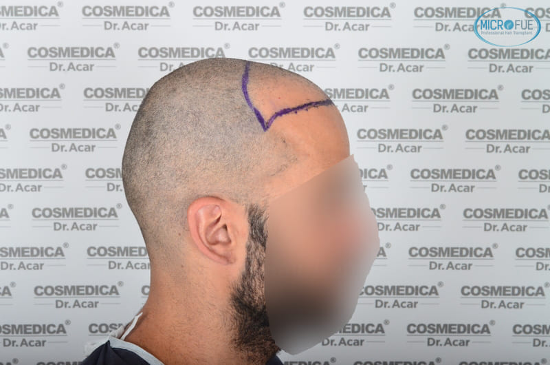 trasplante capilar en Turquía con Microfue resultados excelentes_14(1) trasplante capilar en Turquía con Microfue resultados excelentes_14(1)