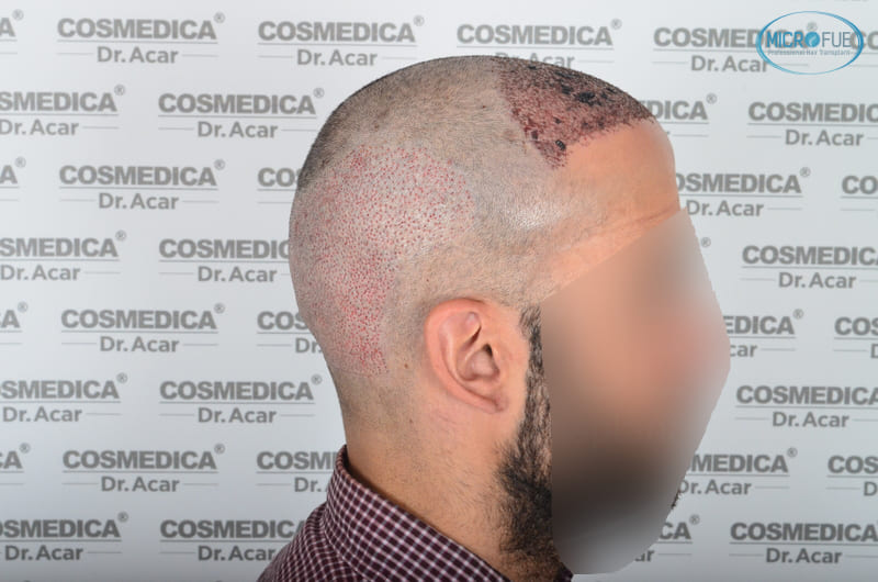 trasplante capilar en Turquía con Microfue resultados excelentes_15(1) trasplante capilar en Turquía con Microfue resultados excelentes_15(1)