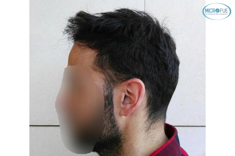 trasplante capilar en Turquía con Microfue resultados excelentes_2(1) trasplante capilar en Turquía con Microfue resultados excelentes_2(1)
