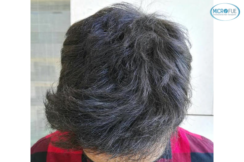 trasplante capilar en Turquía con Microfue resultados excelentes_5(1) trasplante capilar en Turquía con Microfue resultados excelentes_5(1)