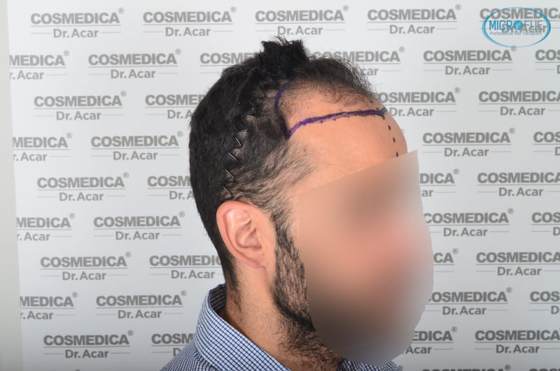 trasplante capilar en Turquía con Microfue resultados excelentes_9(1) trasplante capilar en Turquía con Microfue resultados excelentes_9(1)