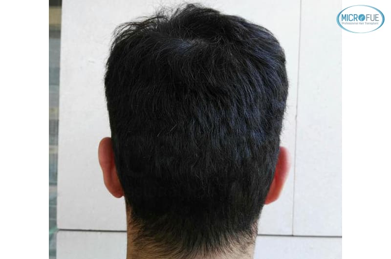 trasplante capilar en Turquía con Microfue resultados excelentes_3(1) trasplante capilar en Turquía con Microfue resultados excelentes_3(1)