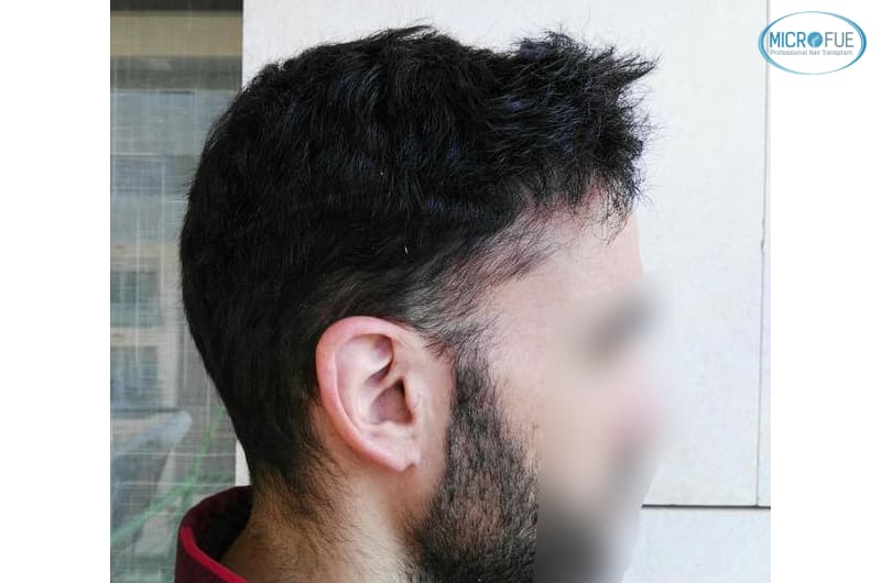 trasplante capilar en Turquía con Microfue resultados excelentes_4(1) trasplante capilar en Turquía con Microfue resultados excelentes_4(1)