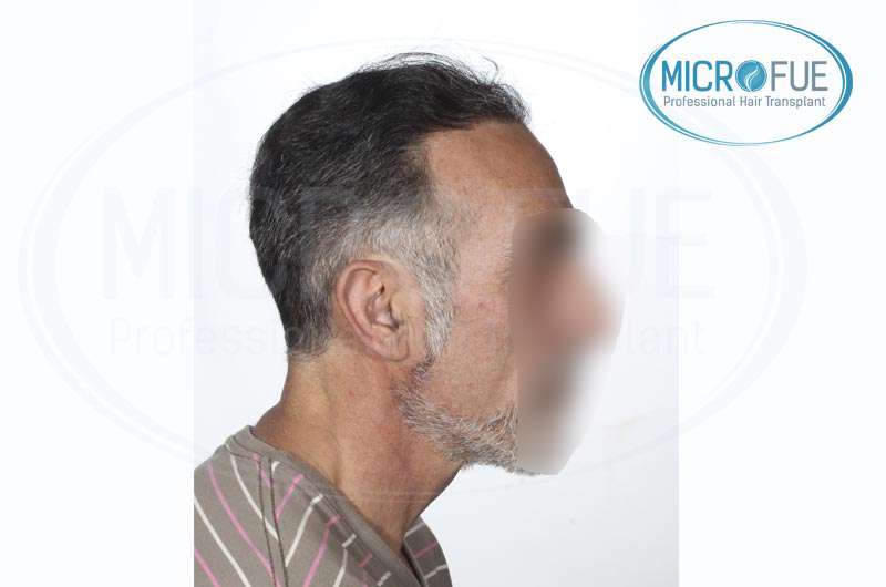 trasplante capilar Microfue resultados Microfue trasplante capilar Microfue resultados Microfue