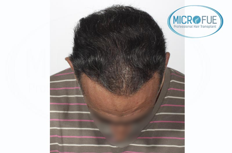 trasplante capilar Microfue en Turquía trasplante capilar Microfue en Turquía