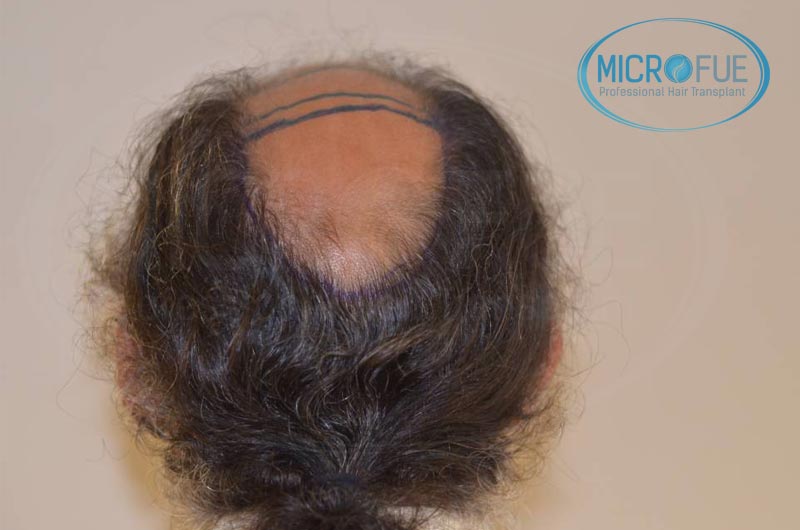trasplante capilar en Turquía con Microfue trasplante capilar en Turquía con Microfue