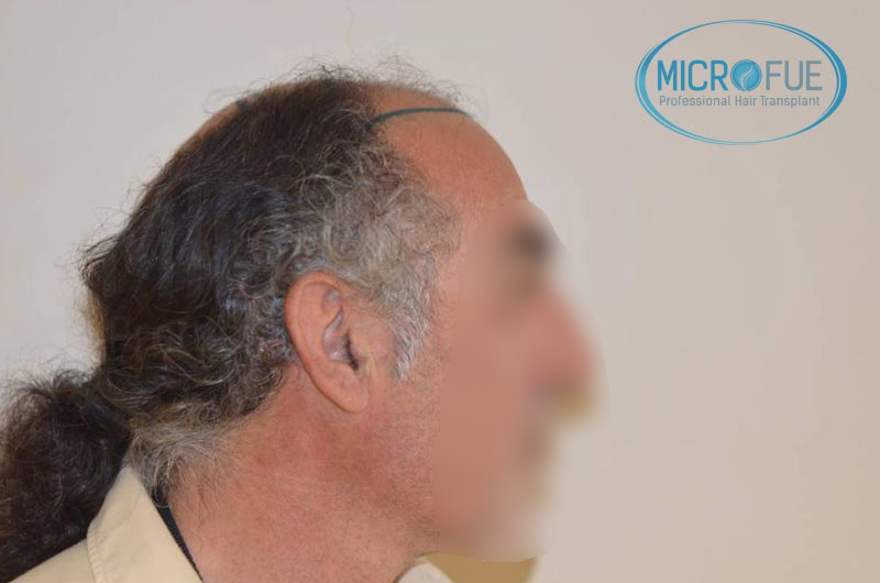 resultados trasplante capilar en Turquía con Microfue