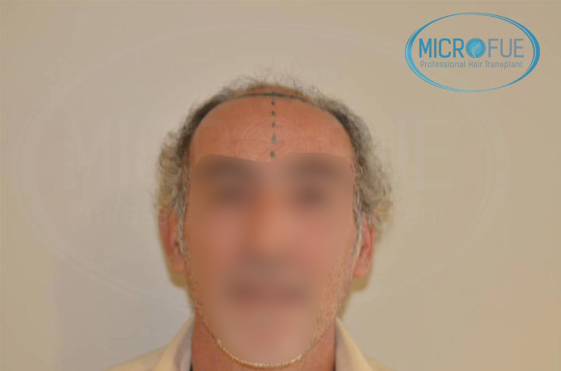 trasplante capilar alopecia avanzada trasplante capilar alopecia avanzada