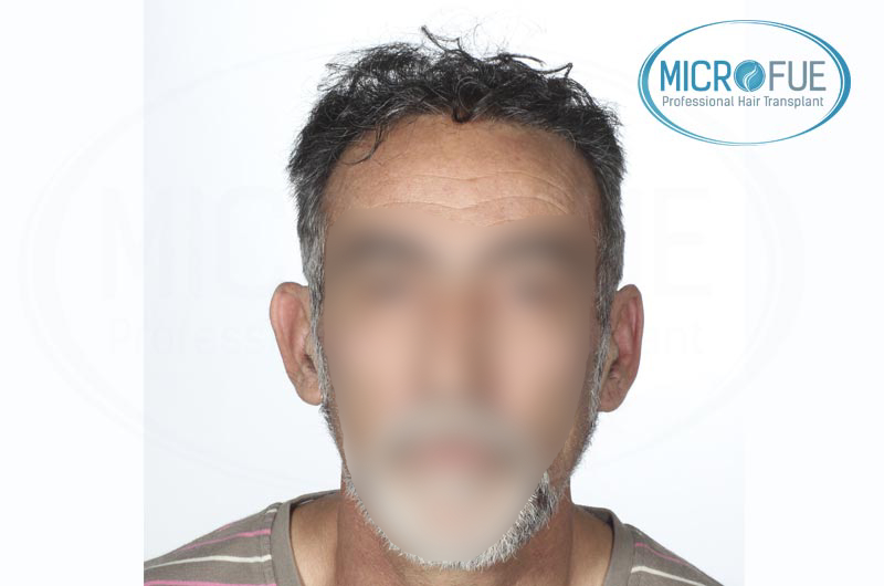 trasplante capilar en Turquía buenos resultados microfue trasplante capilar en Turquía buenos resultados microfue