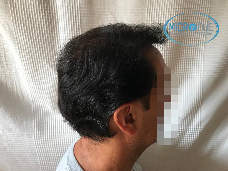Injerto capilar, evolución meses después del trasplante Injerto capilar, evolución meses después del trasplante