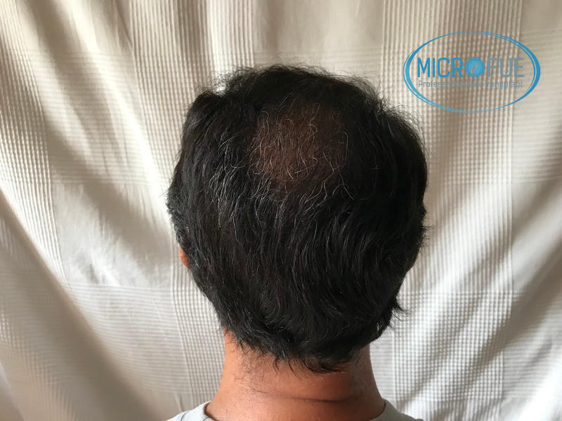 Injerto capilar, evolución meses después del trasplante Injerto capilar, evolución meses después del trasplante