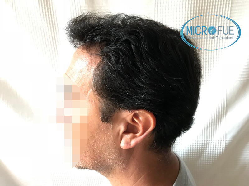 Injerto capilar, evolución meses después del trasplante Injerto capilar, evolución meses después del trasplante