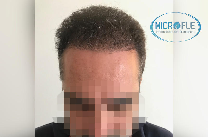 injerto capilar trasplante de pelo injerto capilar trasplante de pelo