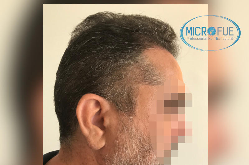 injerto capilar trasplante de pelo injerto capilar trasplante de pelo