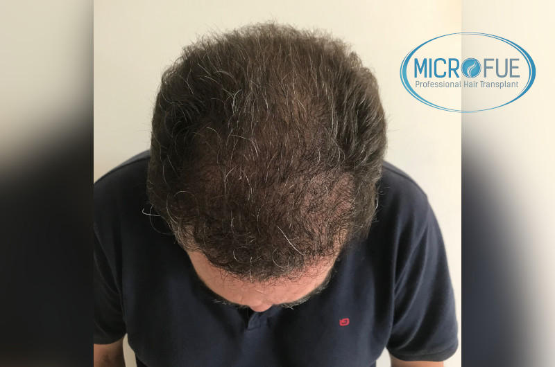 injerto capilar trasplante de pelo injerto capilar trasplante de pelo
