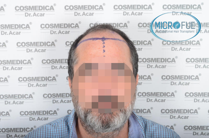 Injerto capilar alopecia Injerto capilar alopecia
