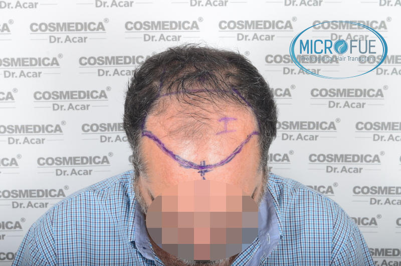 Injerto capilar trasplante de pelo Injerto capilar trasplante de pelo