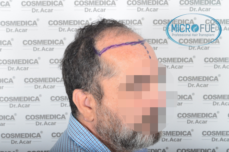 injerto capilar trasplante pelo injerto capilar trasplante pelo
