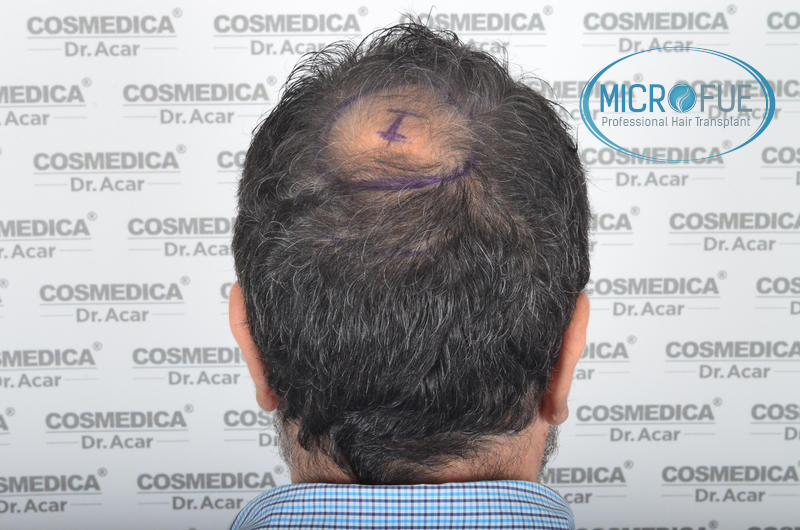 injerto capilar trasplante de pelo injerto capilar trasplante de pelo