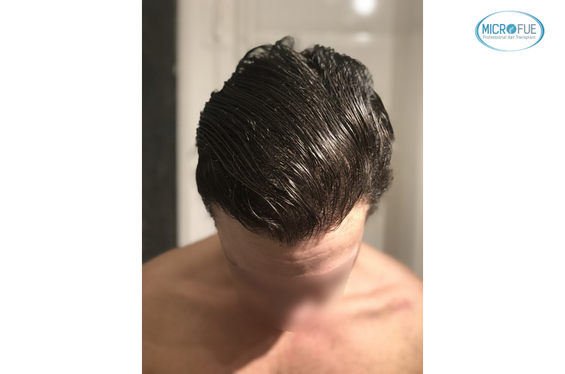 trasplante capilar sin cortar el pelo Microfue (1) trasplante capilar sin cortar el pelo Microfue (1)