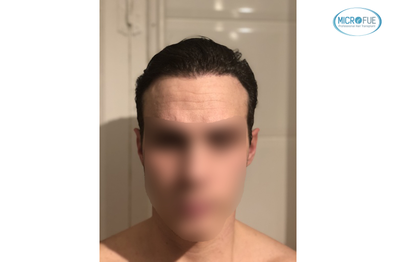 trasplante capilar sin cortar el pelo Microfue (14) trasplante capilar sin cortar el pelo Microfue (14)